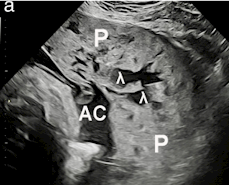 Placental lakes vs lacunae: spot the differences